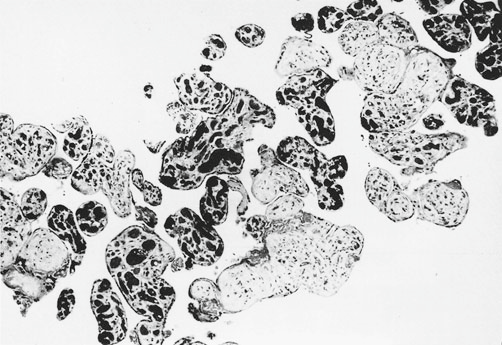 grade 2 chorangiosis x90